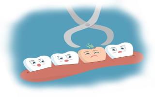 Процесс удаления зубов в Химках