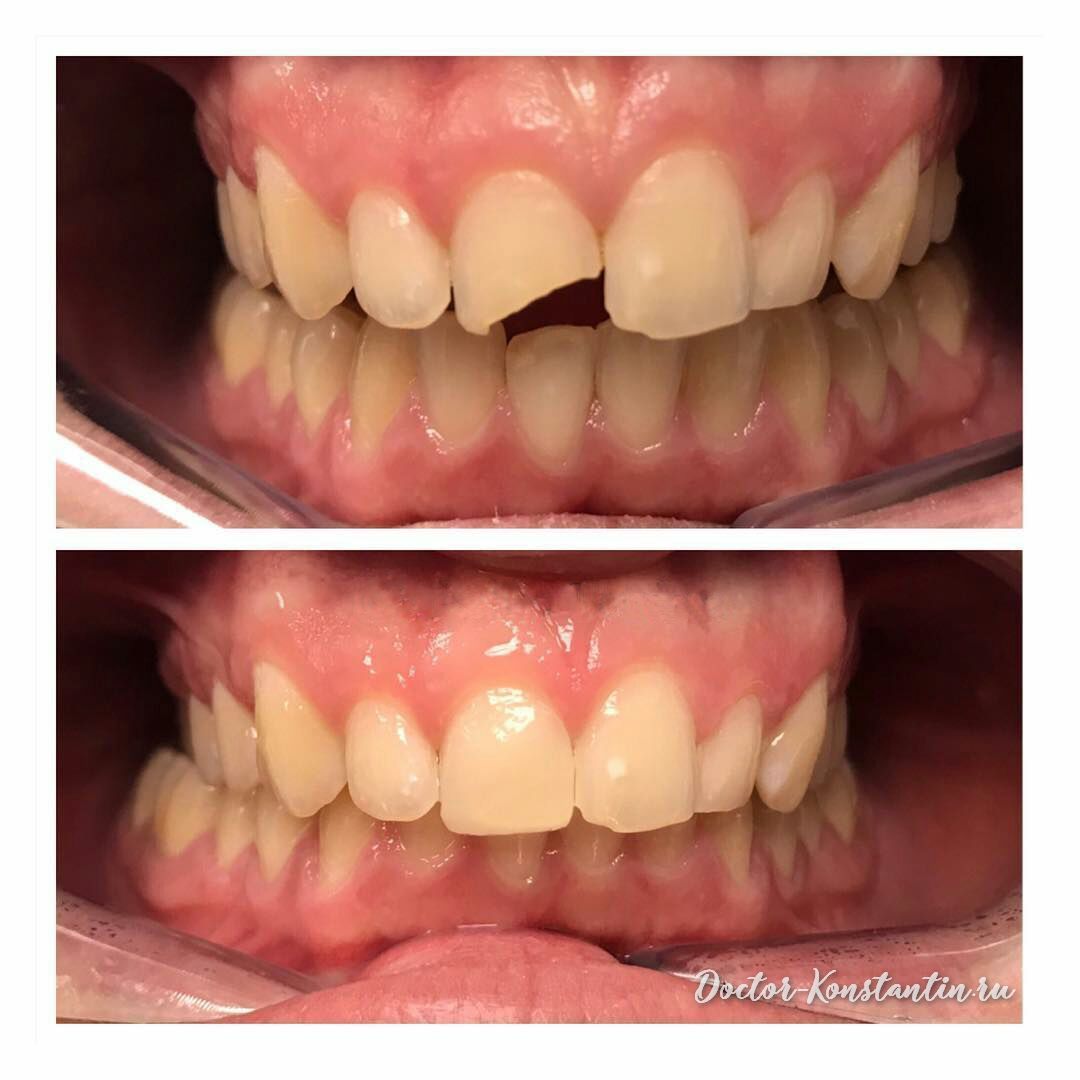 Реабилитация после скола переднего зуба