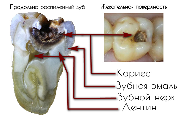 Строение зуба с кариесом