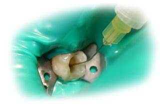Противомикробная обработка зуба